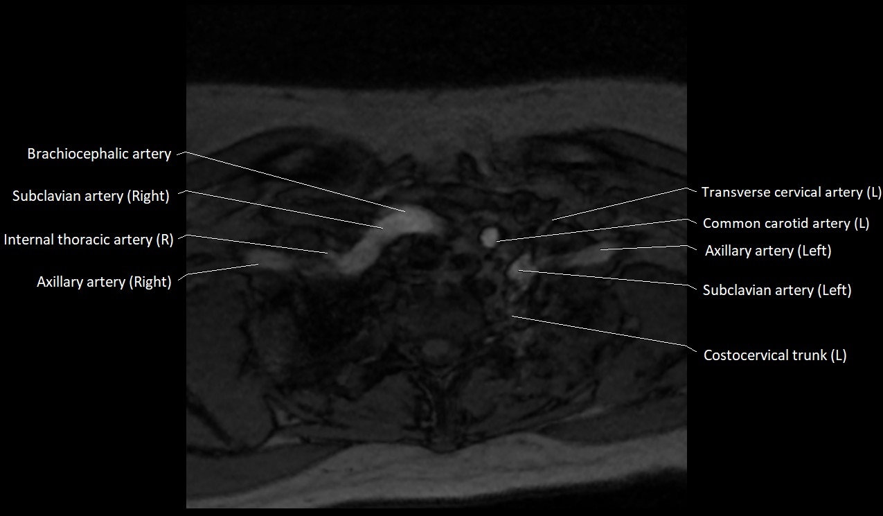Carotid artery anatomy axial 3T image 70.jpg